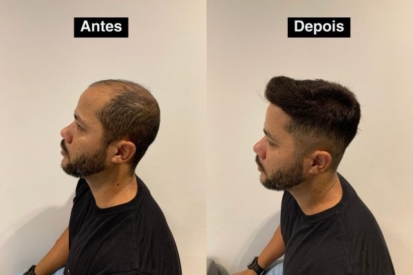 Antes e depois 4